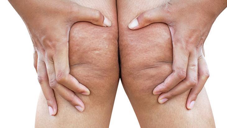 lipodem kadinlarin sessiz cigligi neden kilo veremiyorum diyenler icin cevap p4tSF2SB.jpg